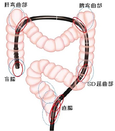 軸保持短縮法